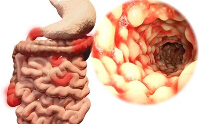 IBD: Crohn’s Disease