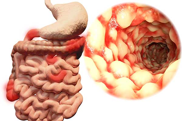 Illustration of the intestines with blowup of interior of large intestine with IBD